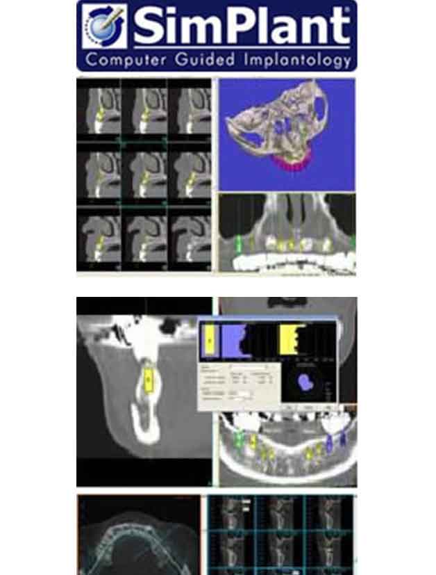 SimPlantによる3D-CT解析