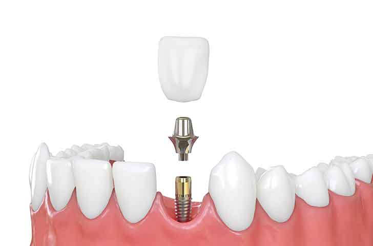 歯を失っても天然歯に近い感覚が取り戻せる治療法