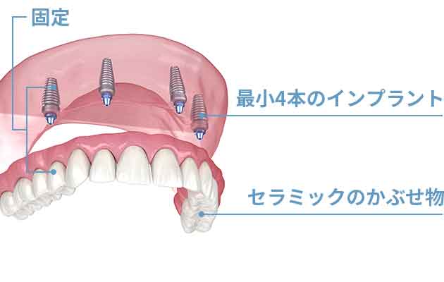 少ないインプラントで多くの歯を支えられる仕組み