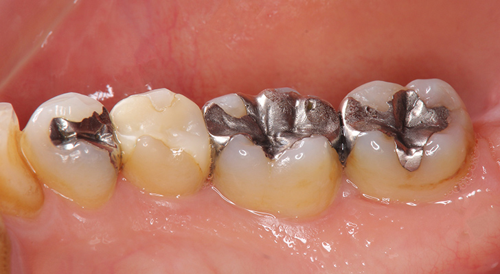 むし歯治療(詰め物・被せ物)