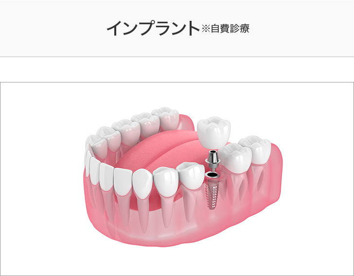 インプラント